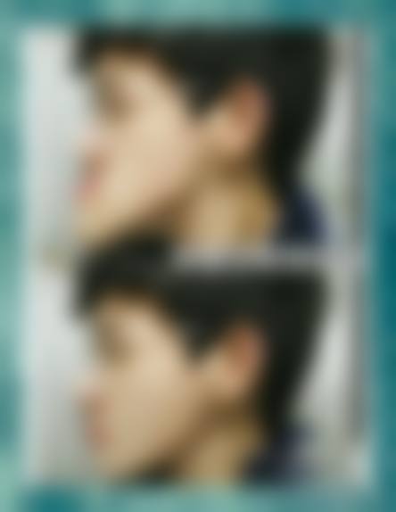 医学定义：地包天是反颌现象