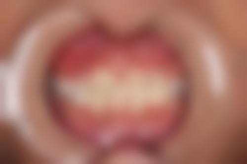 实例分析：地包天矫正成效显著