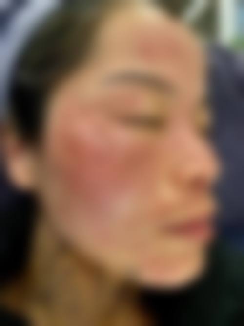 三、鸡西市人民医院烧伤整形科特色项目及技术优势