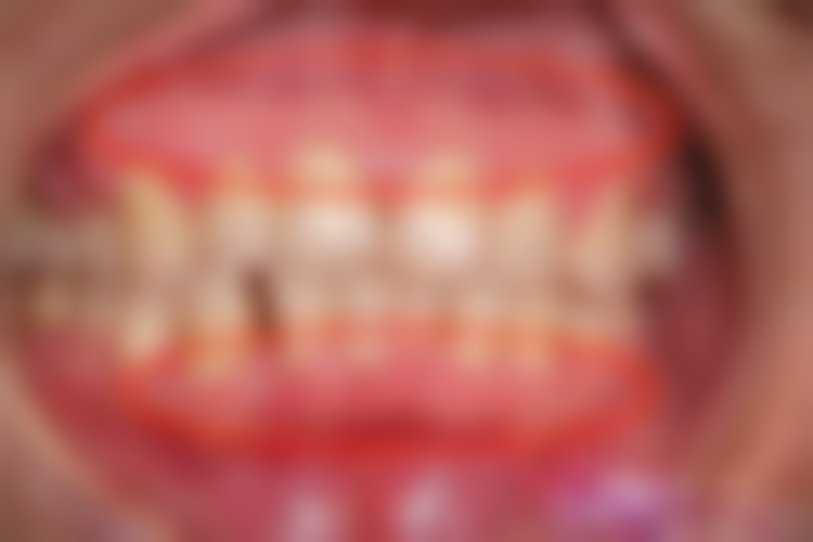 影响补牙材料使用寿命的因素