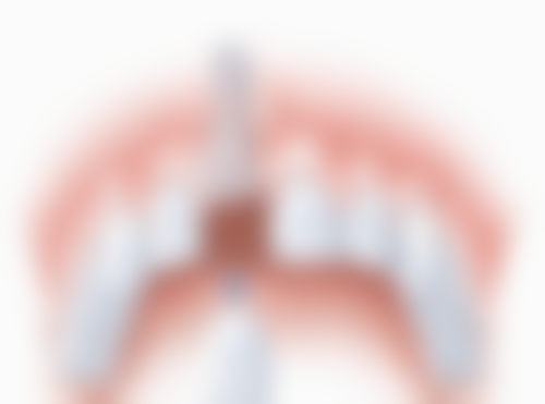 满嘴种植牙的费用情况：了解价格心中有数