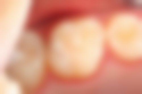 补牙材料价格明细查询