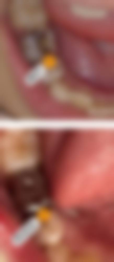 解答补牙常见疑问