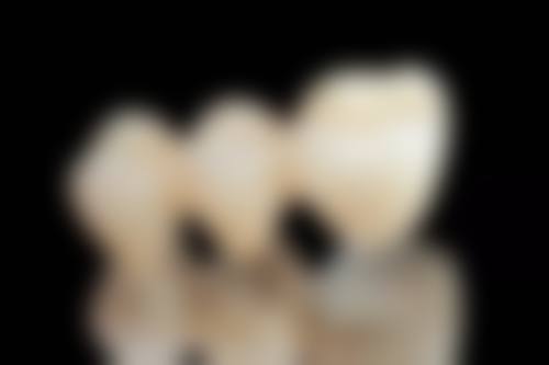 不同品牌种植体对核磁共振检查有无影响