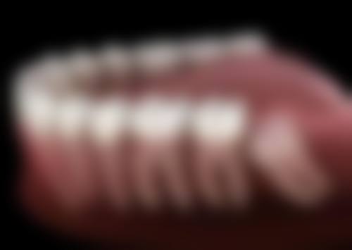 牙套的作用及优势