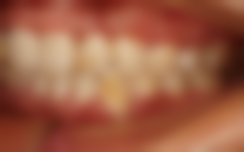 金合金补牙：20年+寿命的“秘密武器”？