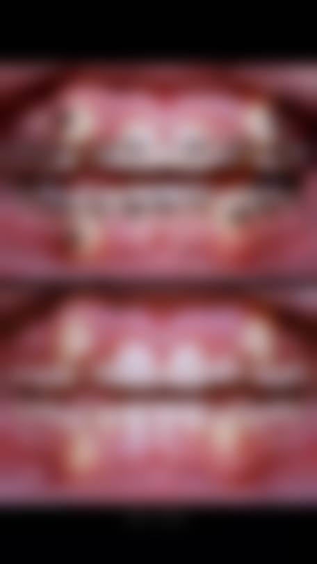 拔牙矫正的利弊分析与注意事项