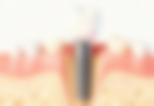 第一次根管治疗后疼痛异常该怎么办？