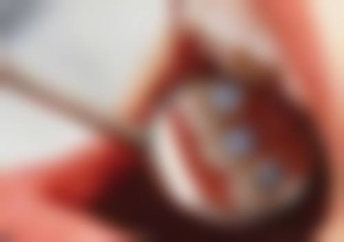 做全口种植牙需要多长时间？常规3-6个月，口腔达标当天种牙当天就能吃饭