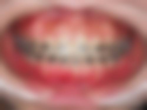 舌侧矫正价格因素