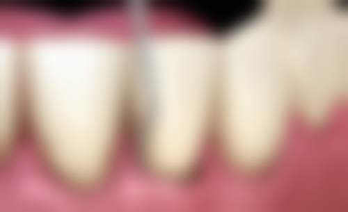 银汞合金材料：曾经经典如今何去何从