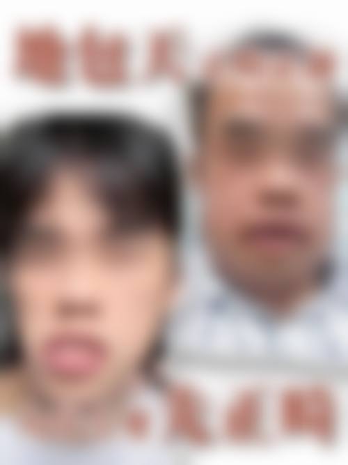 地包天对宝宝的多方面危害