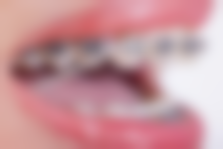 取下烤瓷牙有哪些风险？提前知晓防患