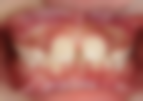 选择小诊所做根管治疗的潜在风险