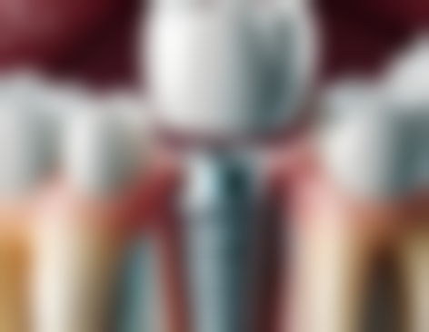 治疗龋齿：解决继发龋问题防止脱落