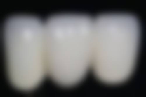 影响做牙冠时间的因素