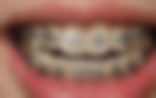 氧化锆全瓷牙有哪些品牌？进口威兰德则武、国产爱尔创翔通，覆盖高中低预算