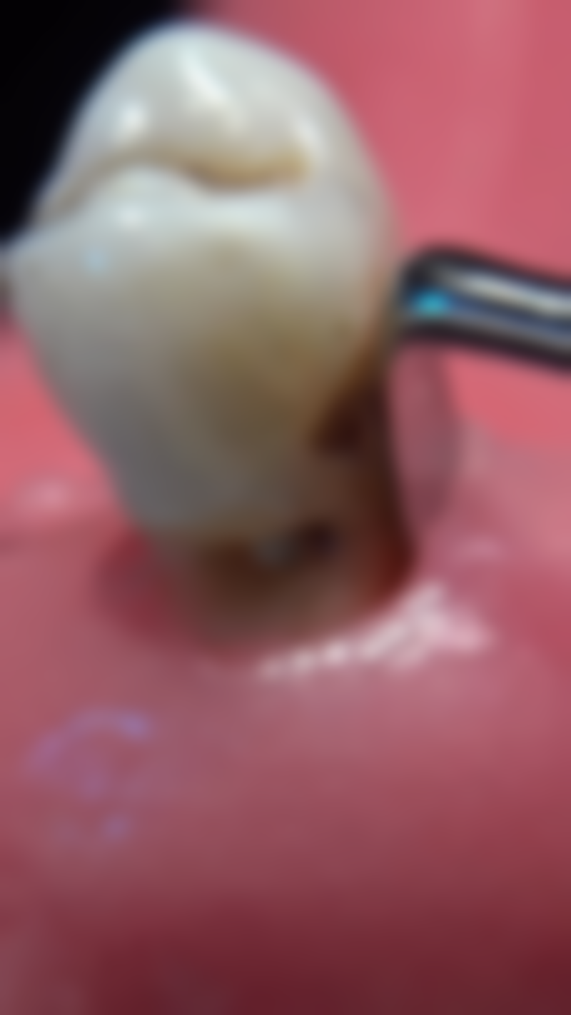 二氧化锆全瓷牙：强度与美观兼备