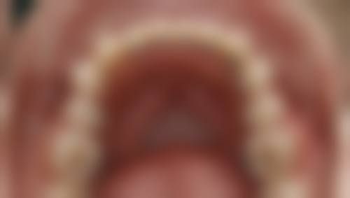 拔牙与不拔牙矫正的区别对比