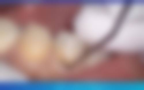 许昌隐形矫正医院在线询问优势