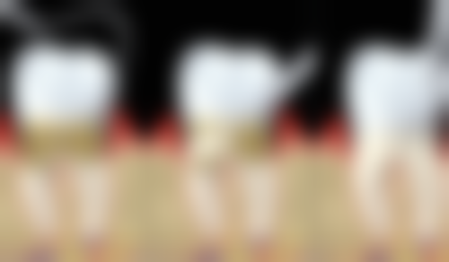 材质与技术：诺保科种植牙的核心优势