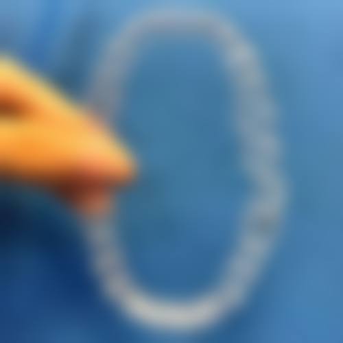 边缘不密合：全瓷牙与牙龈间的隐患缝隙