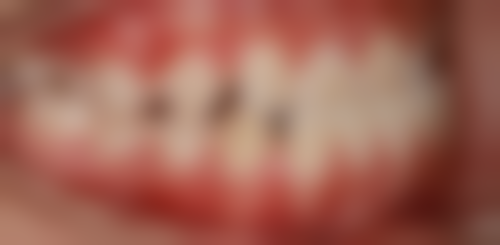 诺保科种植牙怎么样？瑞典进口四级纯钛植体，骨结合快还能做即刻负重