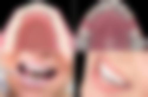 手术矫正：重度骨性地包天的解决之道