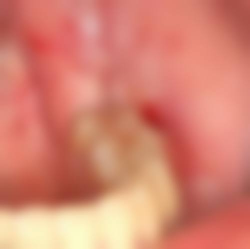 血压140/90可以拔牙吗?稳定达标无严重并发症，经牙内双科医生评估后可安全拔牙