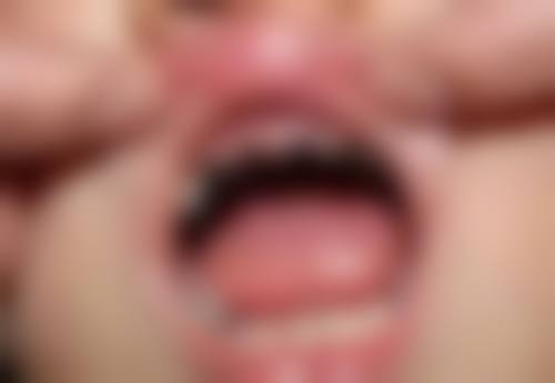 根尖周炎:炎症蔓延,根管治疗保健康