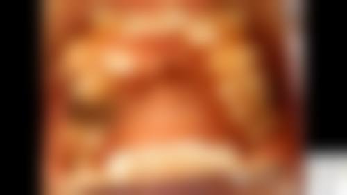 常见的7岁孩子地包天矫正方法