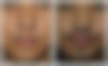 四、厦门碧莲盛植发特色项目及技术优势