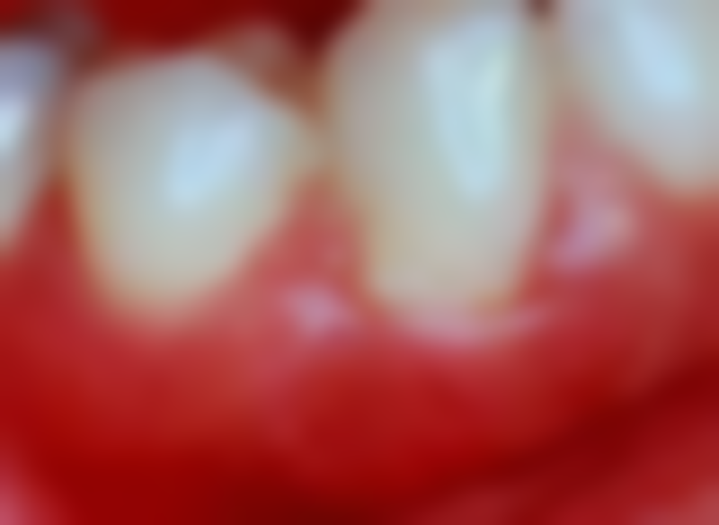 外观大比拼：谁更接近自然牙齿的美丽