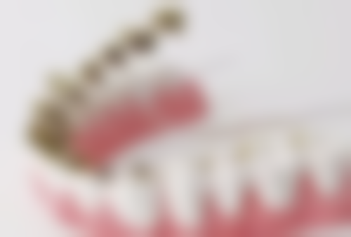 银汞合金：坚固耐用但美观欠佳的传统材料