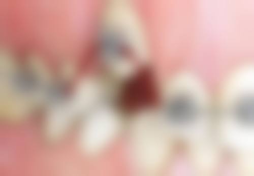 咬合关系不良，拔牙调整上下牙列