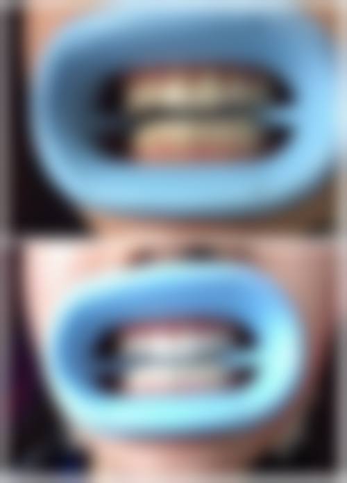 洗牙不含喷砂好不好？牙面色素少、注重性价比选它！常规洗牙100 - 300元搞定