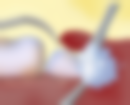 拔牙一年后镶牙的方式选择