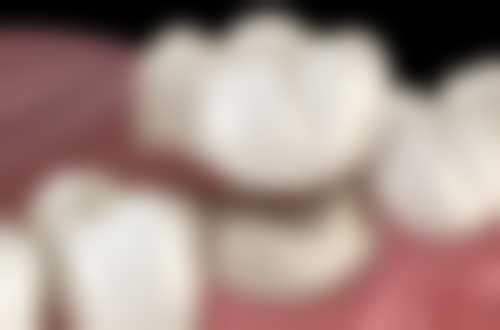 治疗后的牙齿变化与精心护理