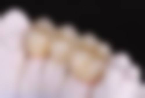 选择爱迪特全瓷牙的注意事项