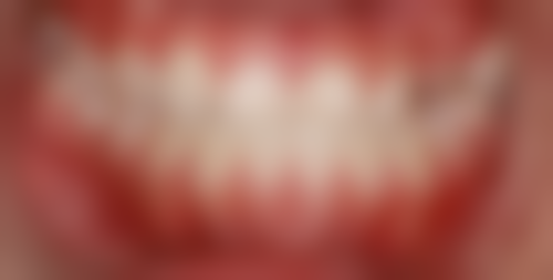 中低端韩国种植牙的适用人群与特点