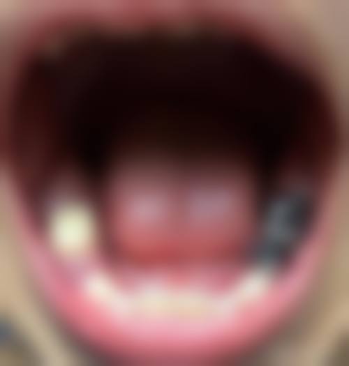 辽宁拔牙24小时在线询问：儿童拔牙情况