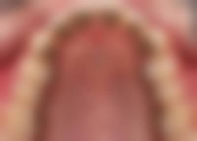 医生分享的隐形矫正注意事项