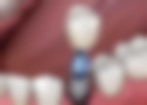 补牙后不同阶段的饮食建议