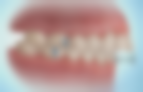 6岁孩子根管治疗的过程与注意事项