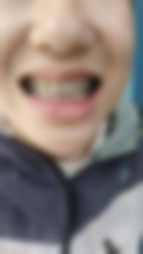 地包天矫正的至佳时间是什么时候？