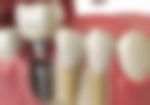 不同品牌种植牙价格