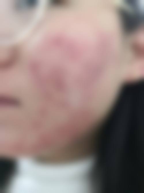 七、阳泉城南皮肤病医院预约挂号方式及流程