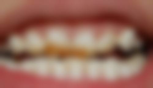 不同治疗难度下的疼痛消失时间