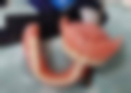 洗牙对已有蛀牙的影响：是福还是祸？