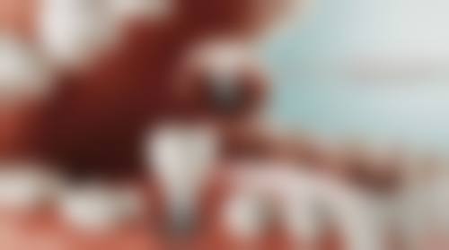 金华其他种植牙医院推荐